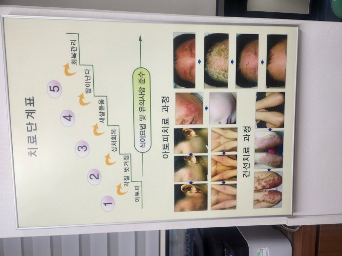 손발 습진 치료 잘하는 한의원